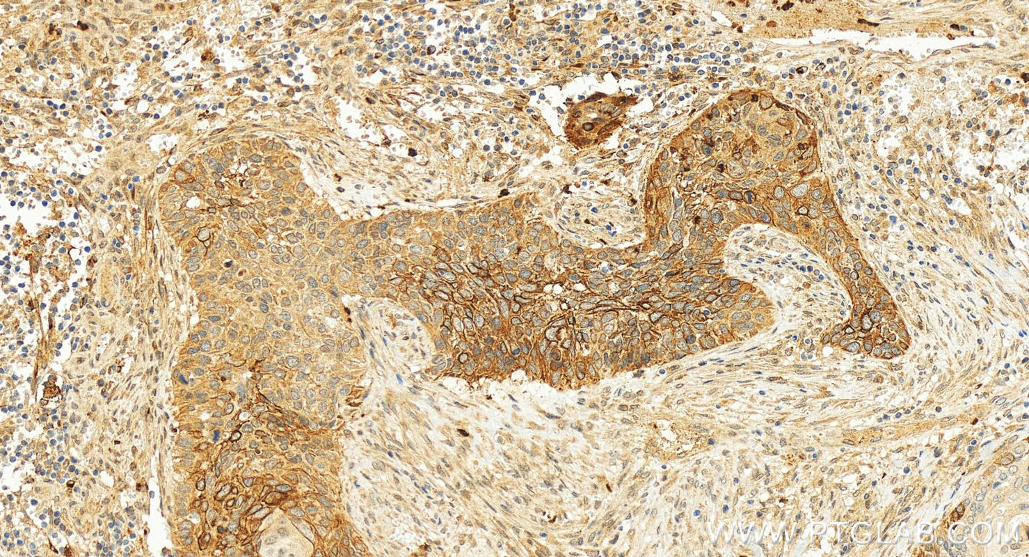 IHC staining of human cervical cancer using 30805-1-AP