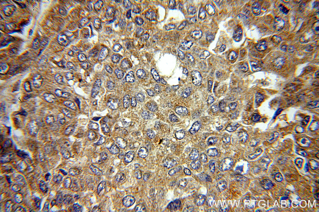 IHC staining of human liver cancer using 14244-1-AP