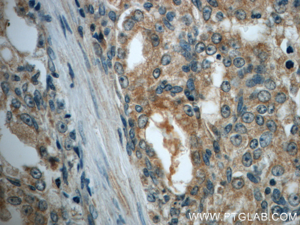 IHC staining of human prostate cancer using 18087-1-AP