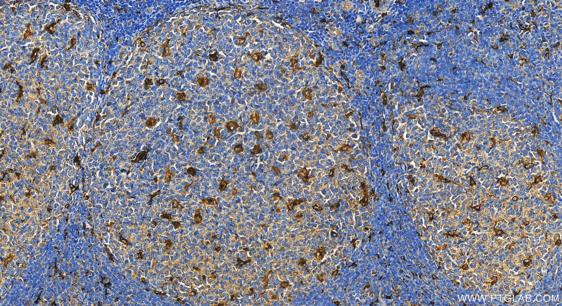 IHC staining of human tonsillitis using 27306-1-AP