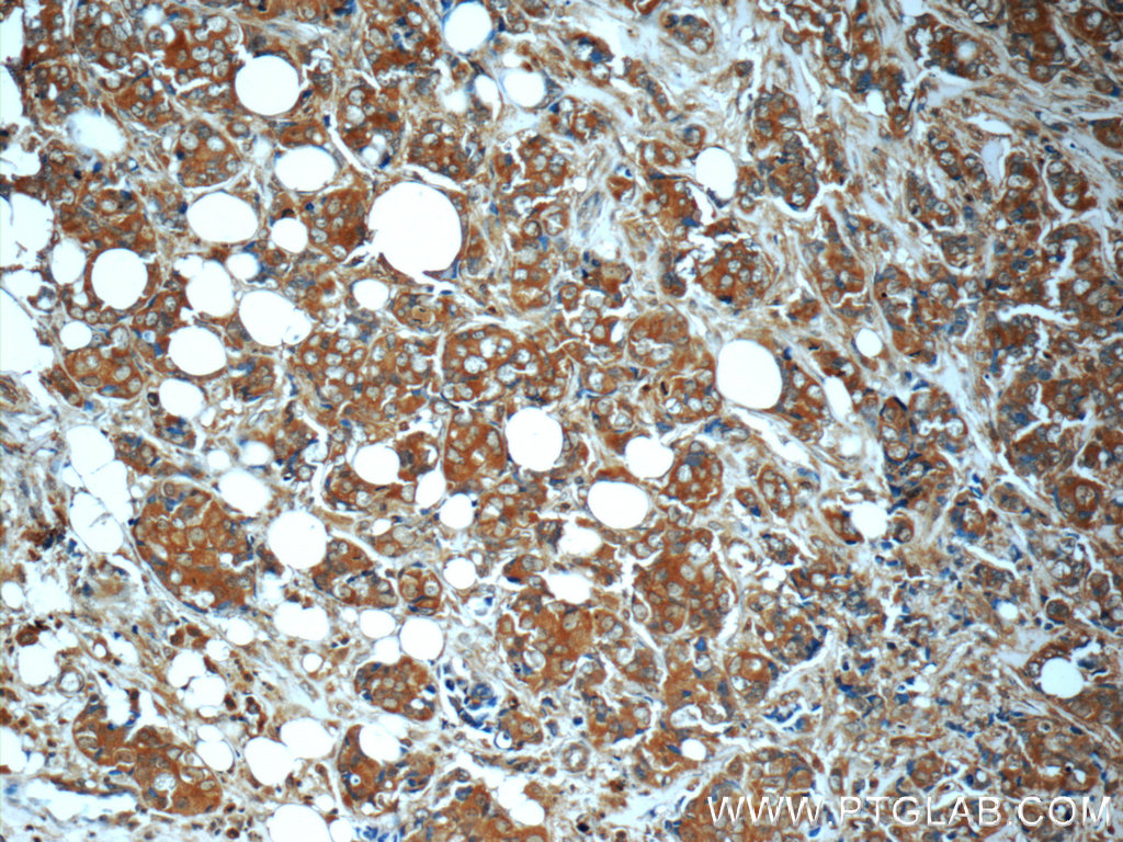 IHC staining of human breast cancer using 24697-1-AP