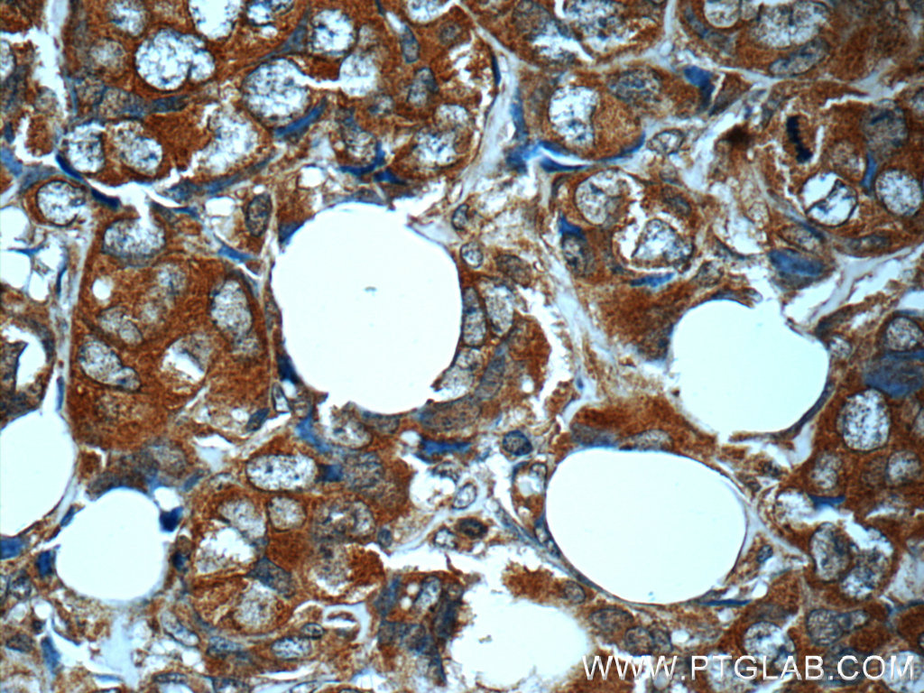 IHC staining of human breast cancer using 24697-1-AP