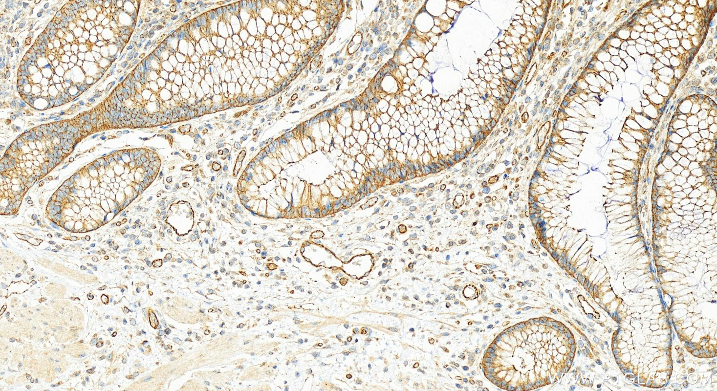 IHC staining of human colon cancer using 15886-1-AP