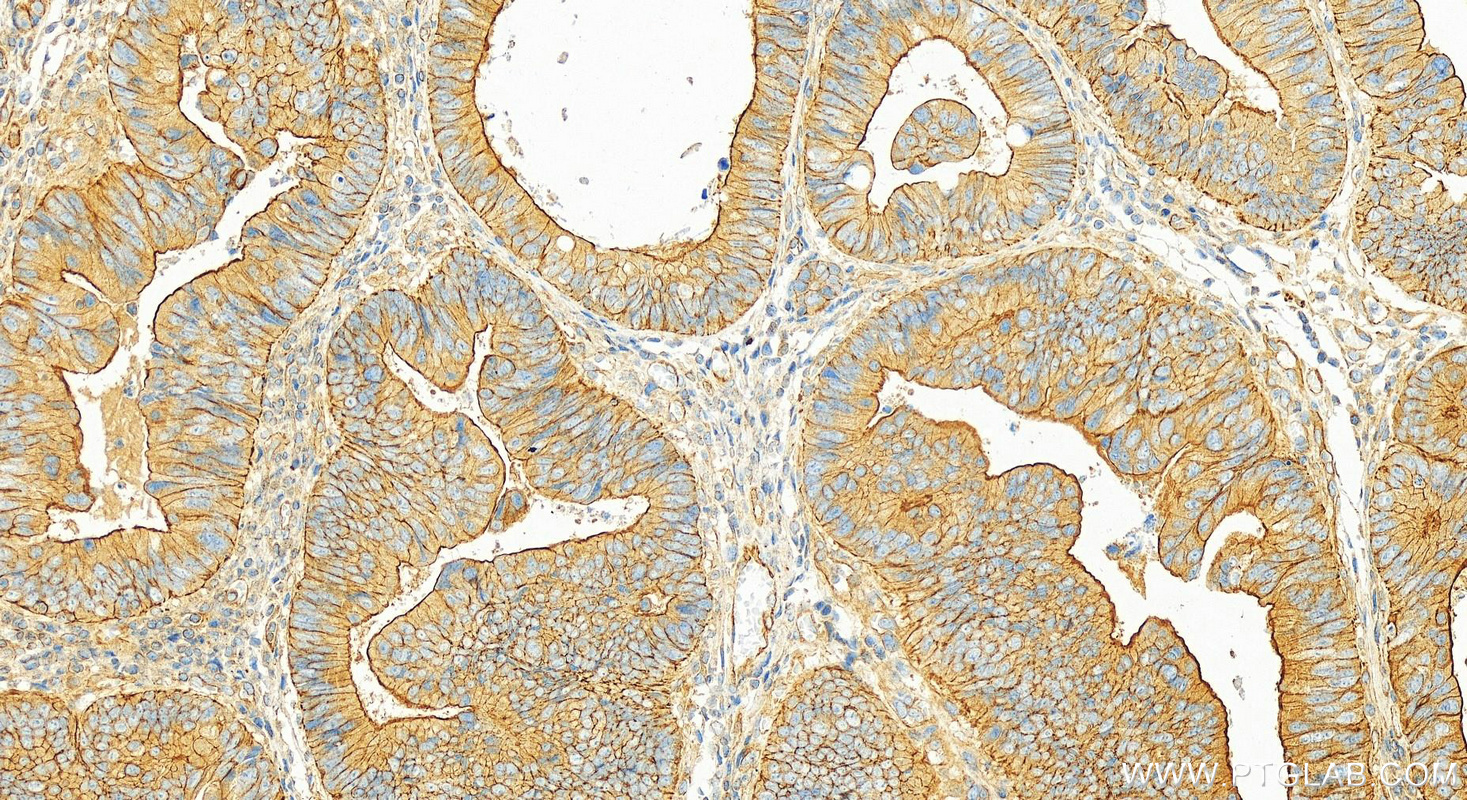 IHC staining of human colon cancer using 15886-1-AP