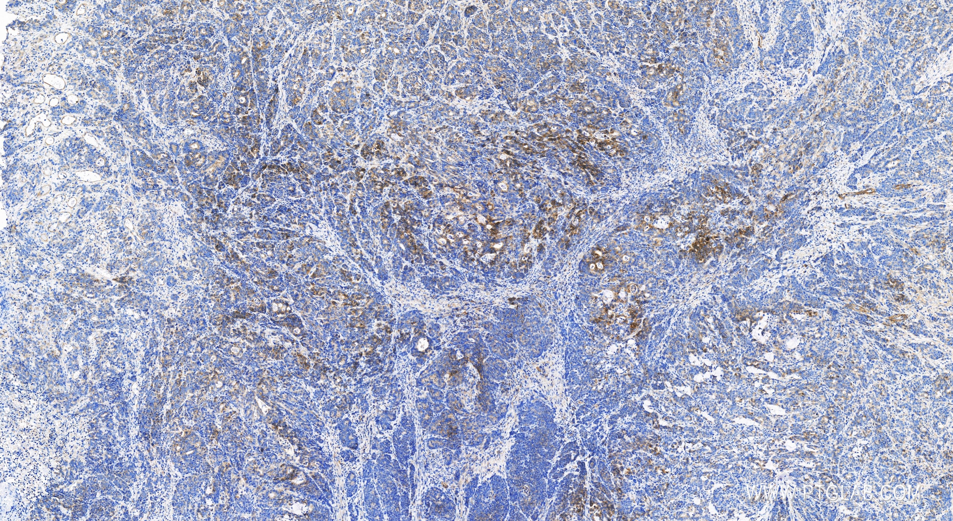 IHC staining of human stomach cancer using 83705-2-RR (same clone as 83705-2-PBS)