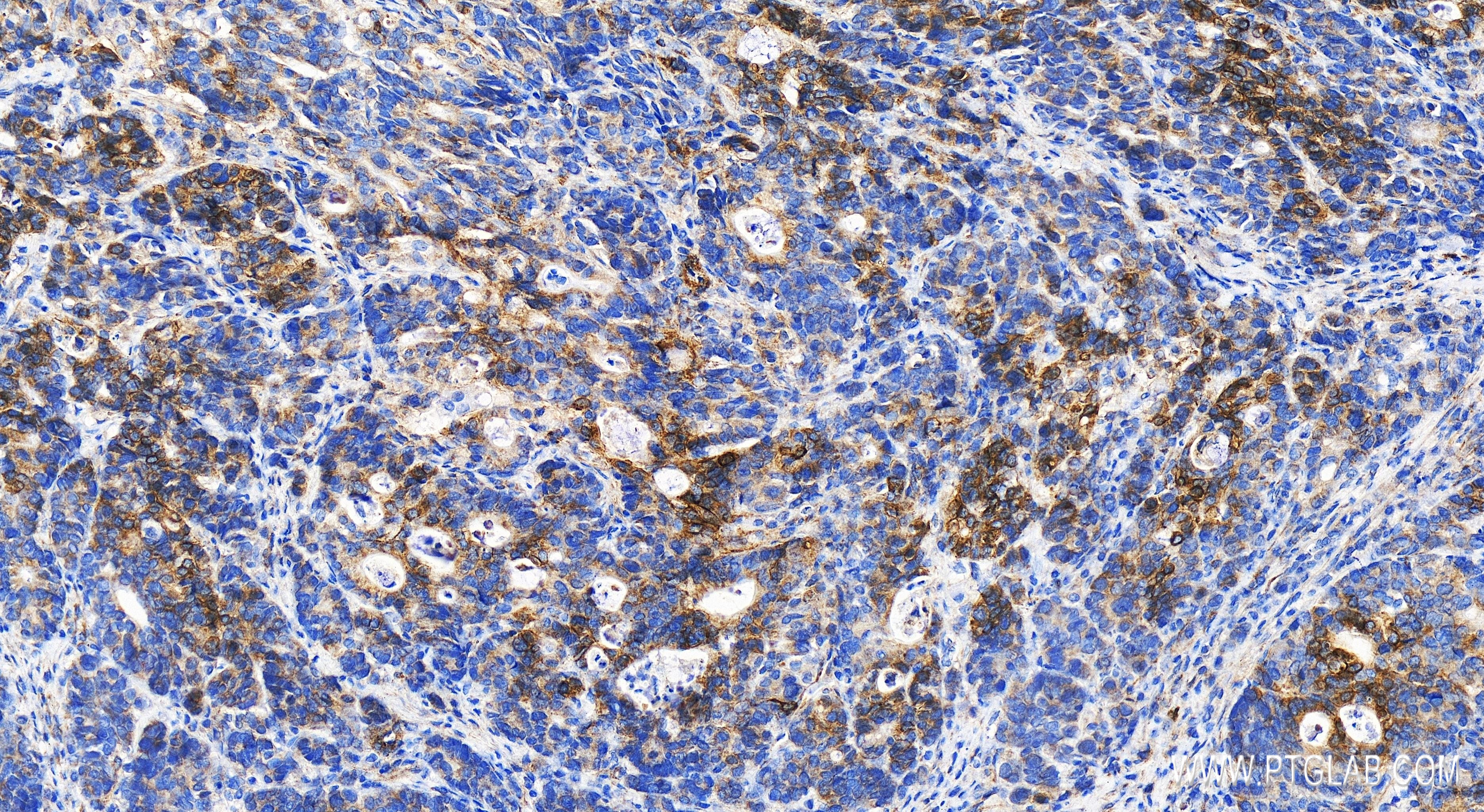 IHC staining of human stomach cancer using 83705-2-RR (same clone as 83705-2-PBS)