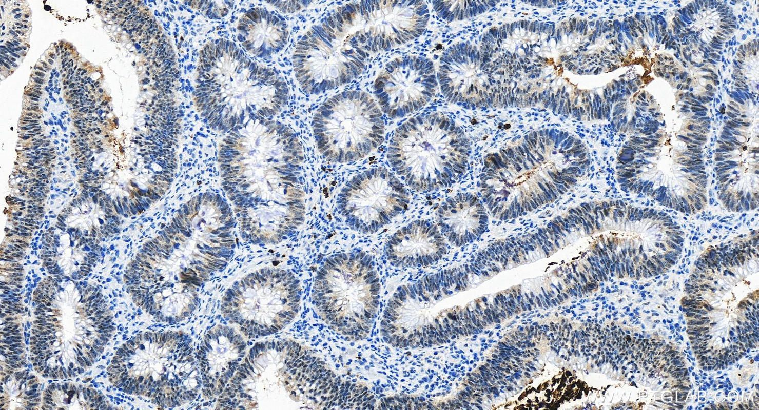 IHC staining of human colon cancer using 81610-1-RR