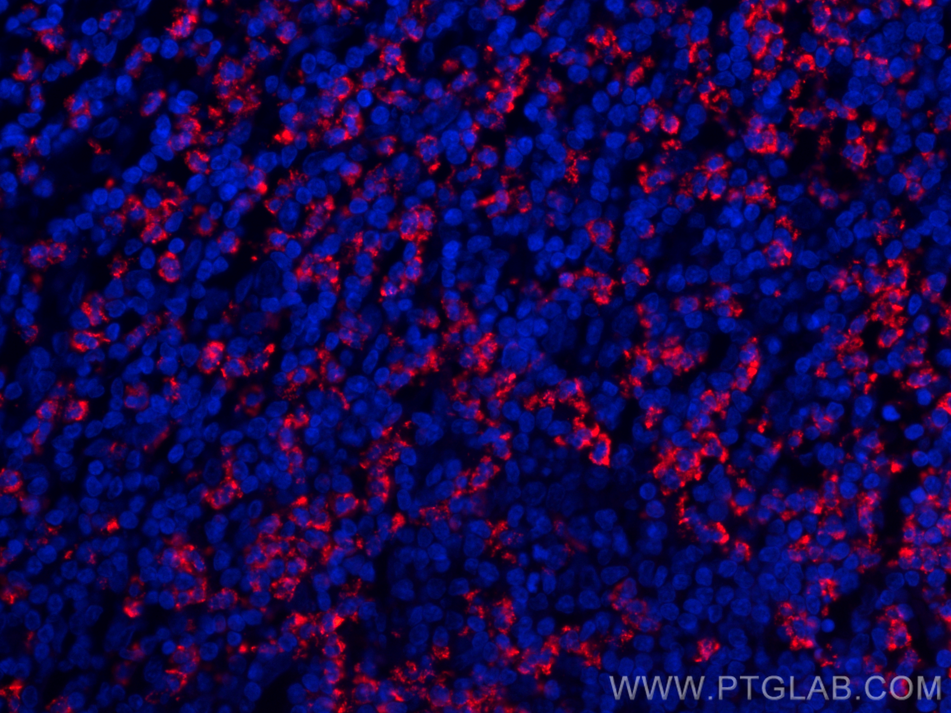 IF Staining of human appendicitis using CL594-66177