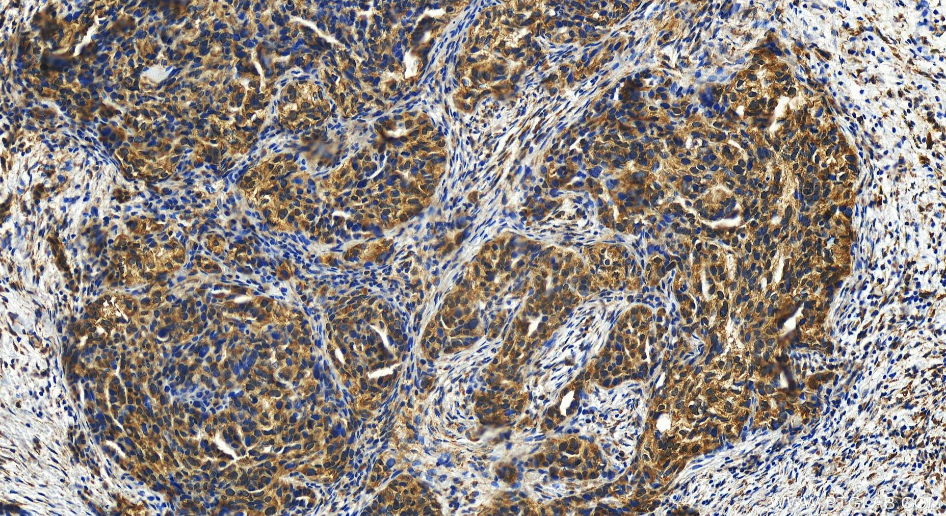 IHC staining of human ovary cancer using 15313-1-AP