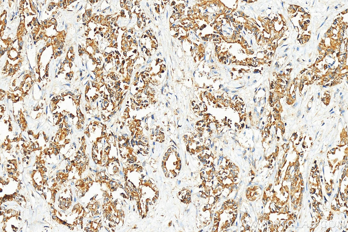 IHC staining of human intrahepatic cholangiocarcinoma using 10310-1-AP