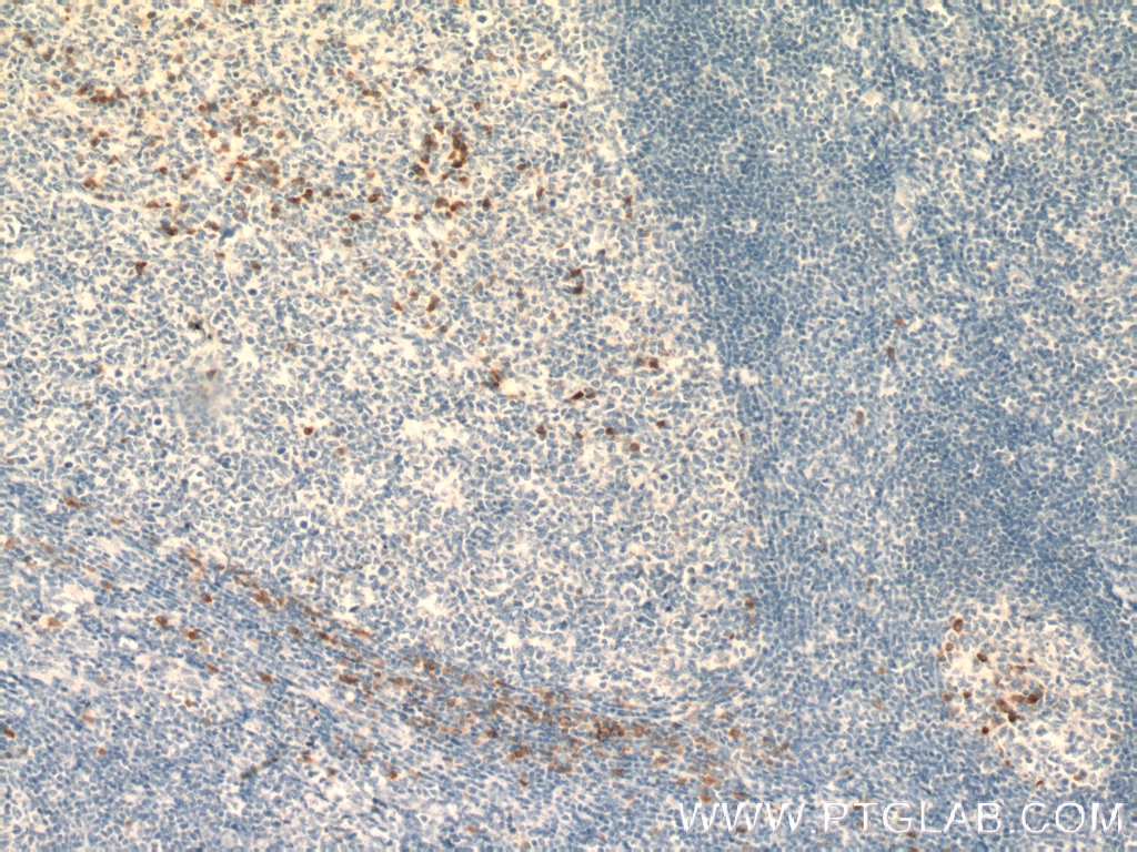 IHC staining of human tonsillitis using 22375-1-AP