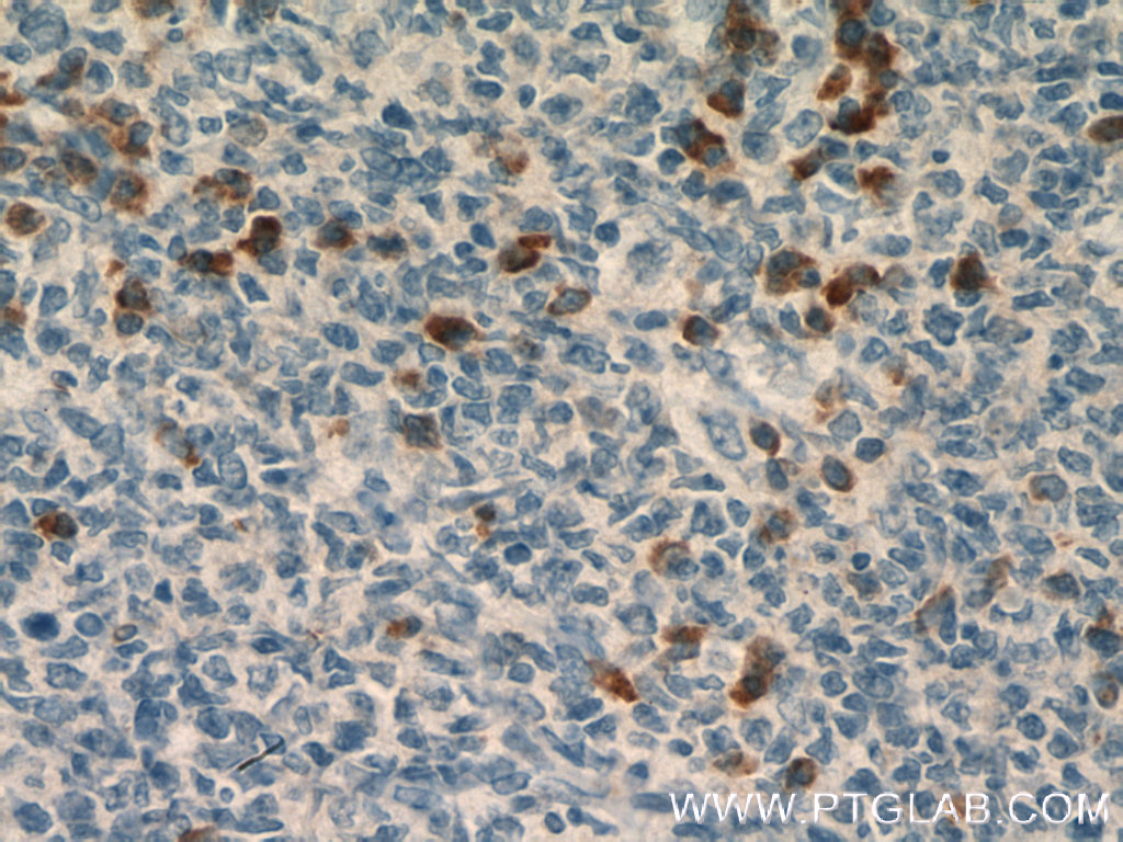 IHC staining of human tonsillitis using 22375-1-AP