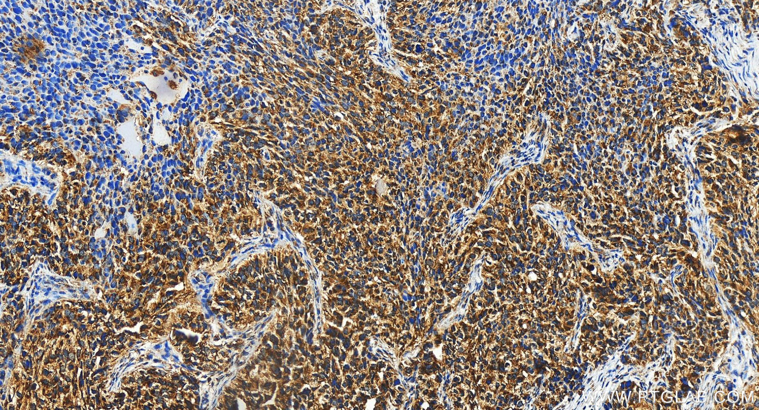 IHC staining of human ovary cancer using 16392-1-AP