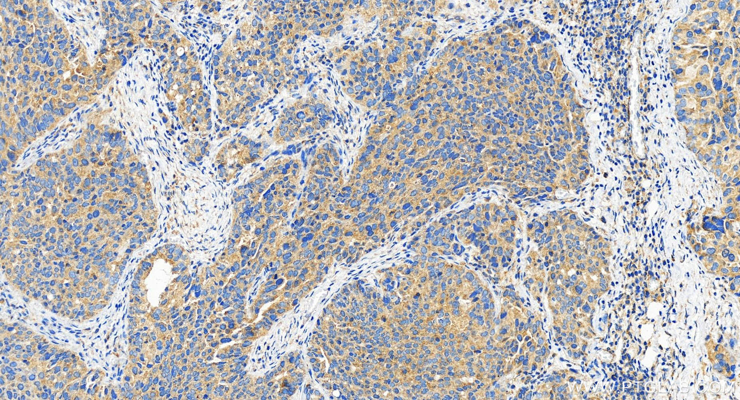 IHC staining of human ovary cancer using 29792-1-AP