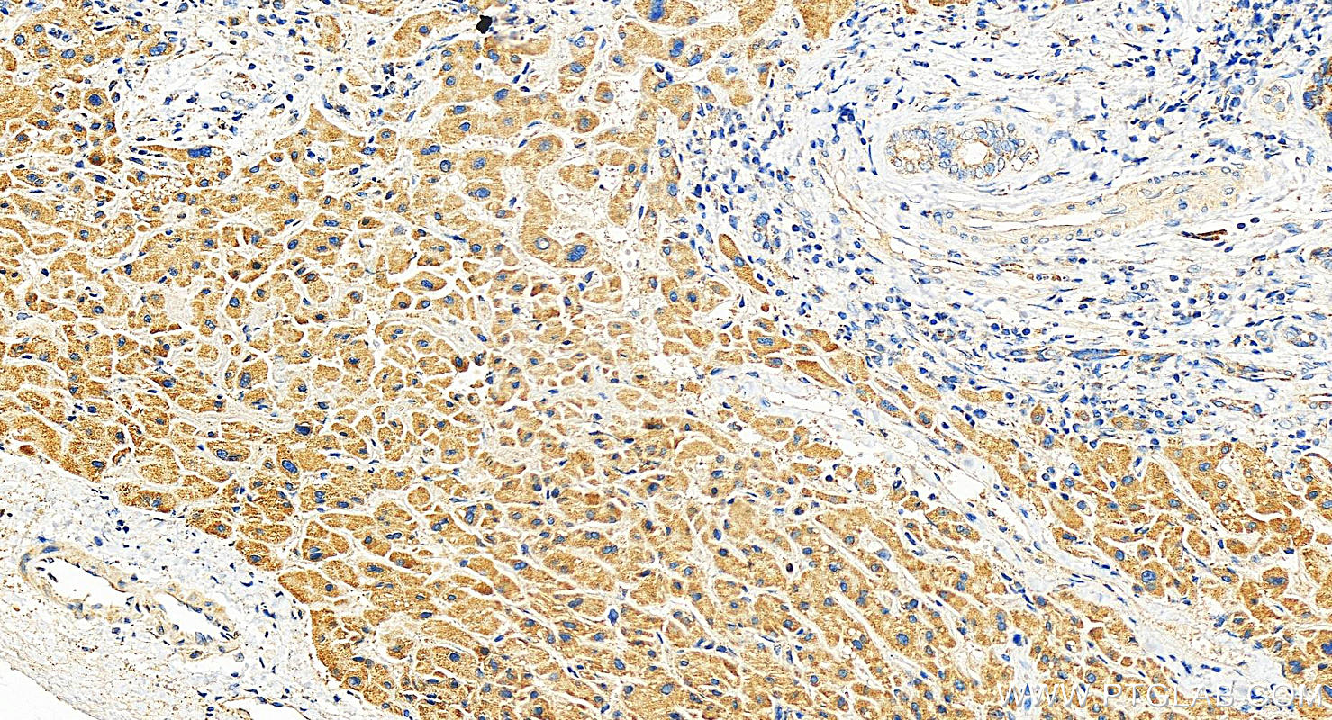 IHC staining of human intrahepatic cholangiocarcinoma using 15178-1-AP