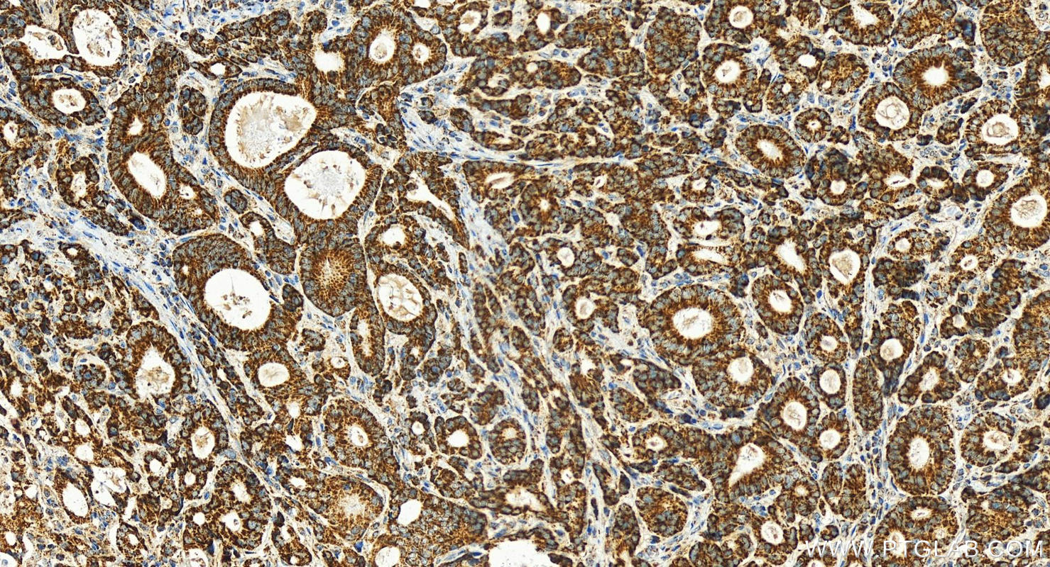 IHC staining of human stomach cancer using 16517-1-AP