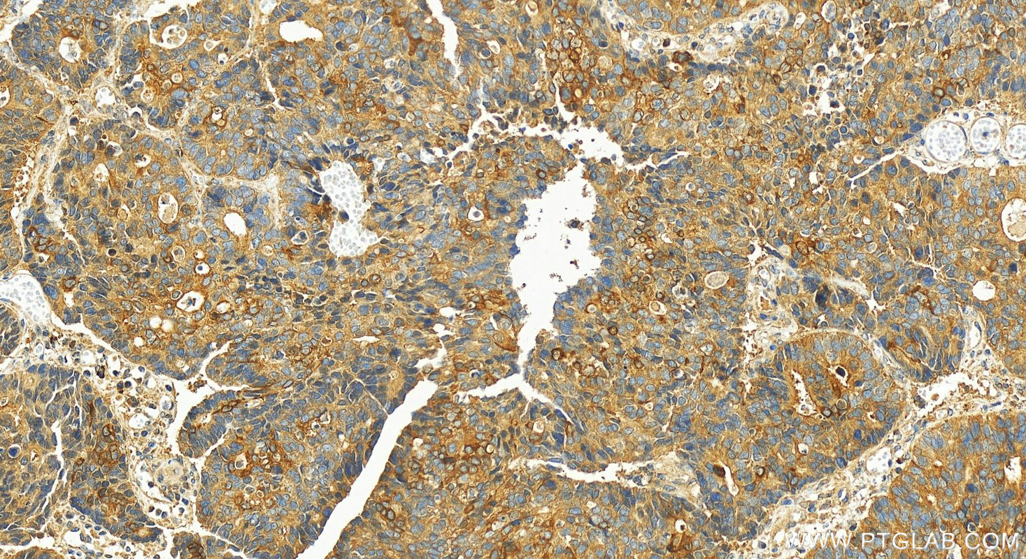 IHC staining of human stomach cancer using 29522-1-AP (same clone as 29522-1-PBS)