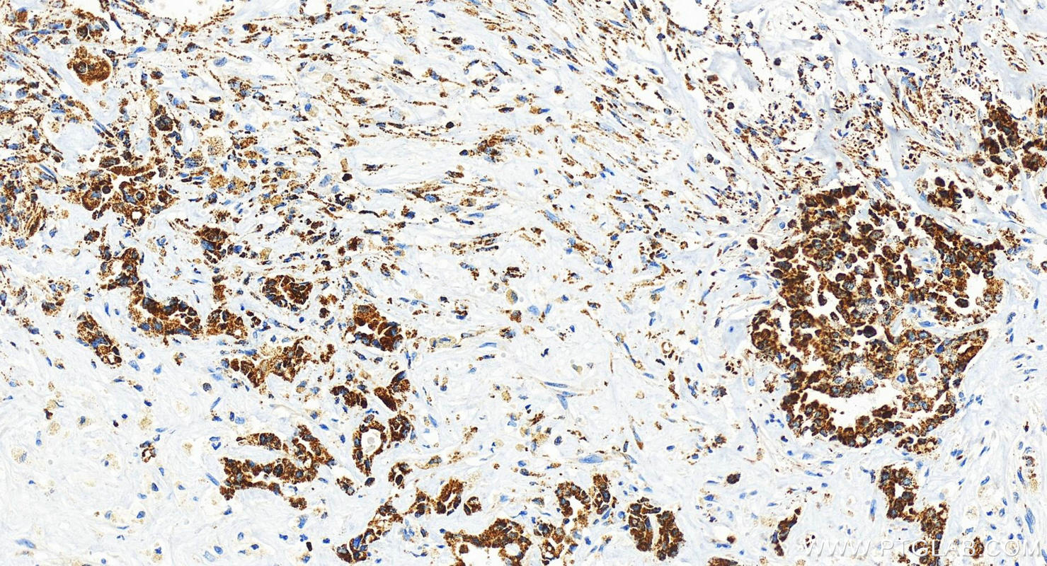 IHC staining of human intrahepatic cholangiocarcinoma using 83515-4-RR