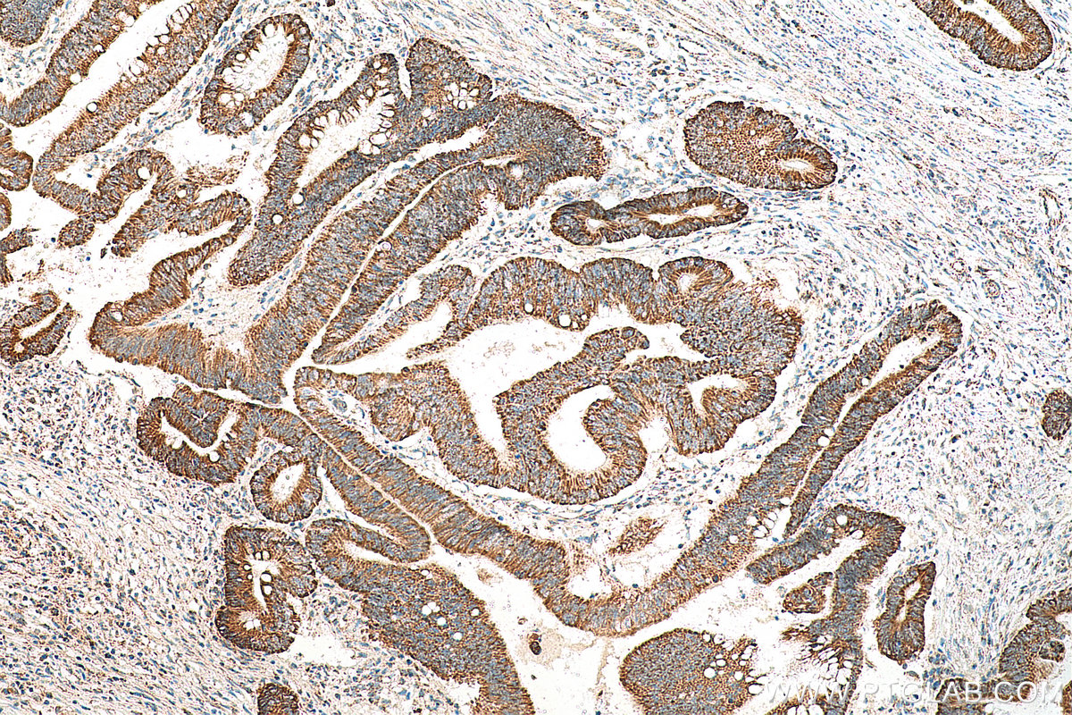 IHC staining of human colon cancer using 17679-1-AP