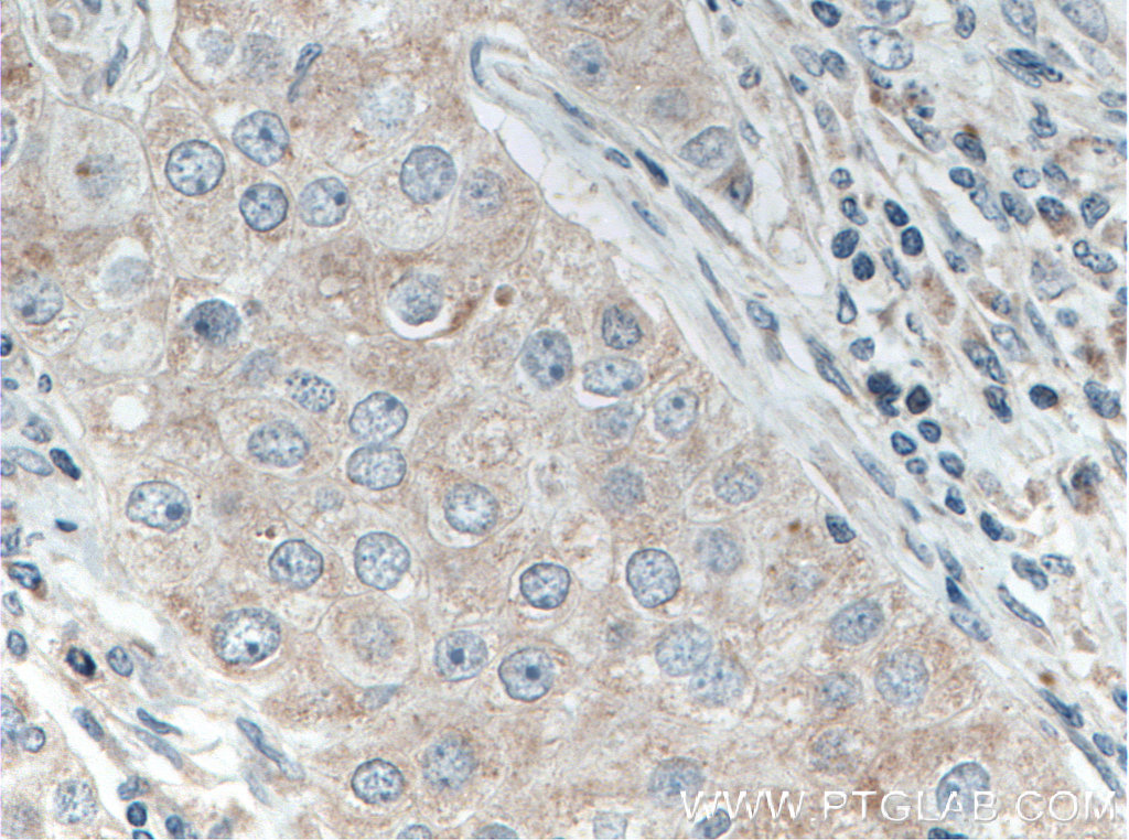 IHC staining of human breast cancer using 15342-1-AP