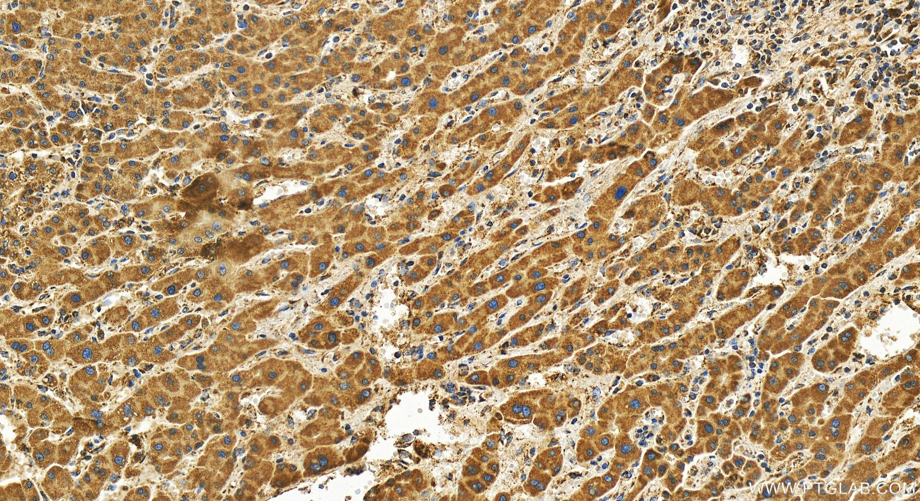 IHC staining of human intrahepatic cholangiocarcinoma using 82741-2-RR (same clone as 82741-2-PBS)