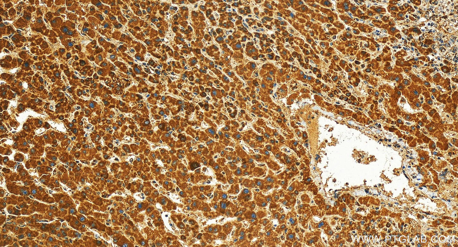 IHC staining of human intrahepatic cholangiocarcinoma using 16235-1-AP