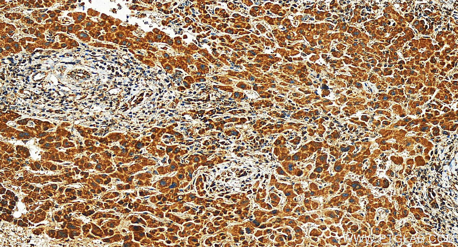 IHC staining of human intrahepatic cholangiocarcinoma using 15277-1-AP