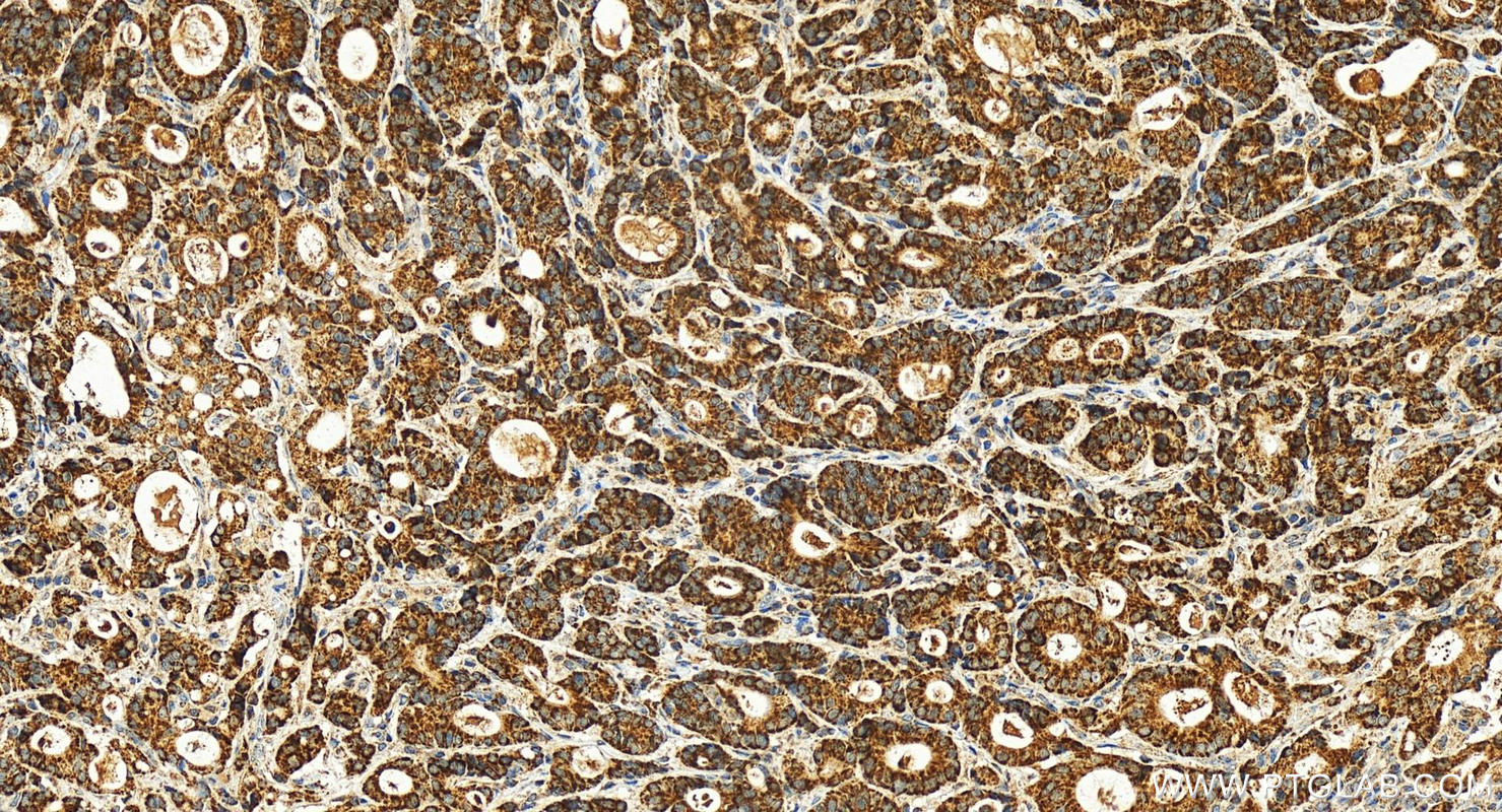 IHC staining of human stomach cancer using 16288-1-AP