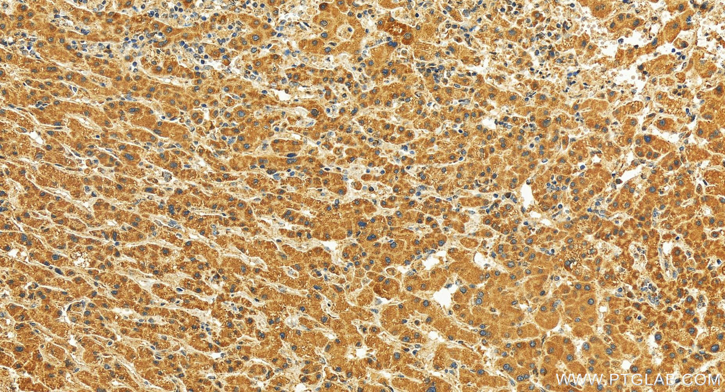 IHC staining of human intrahepatic cholangiocarcinoma using 16533-1-AP