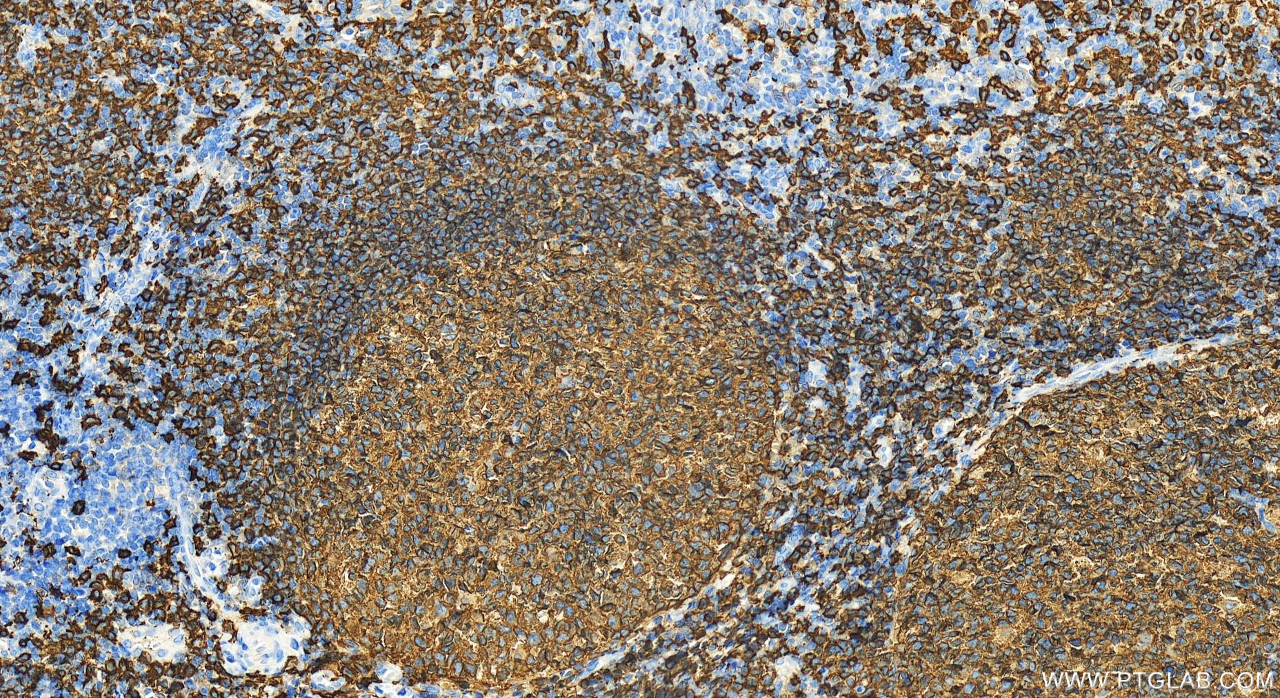 IHC staining of human tonsillitis using 24828-1-AP