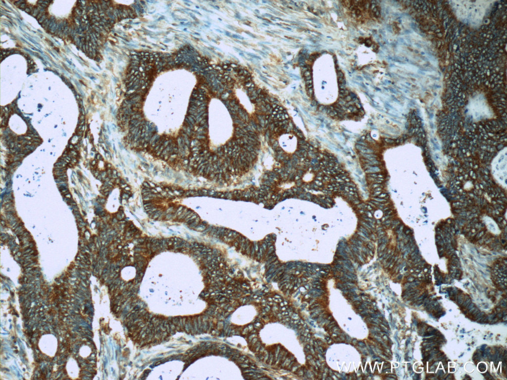 IHC staining of human colon cancer using 13293-1-AP