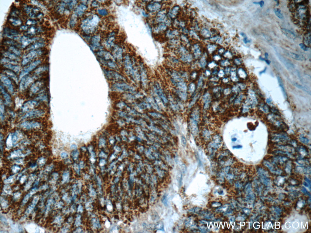 IHC staining of human colon cancer using 13293-1-AP