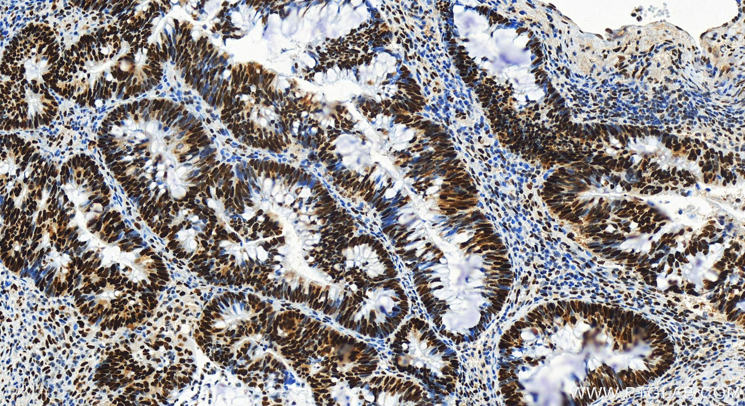 IHC staining of human colon  cancer using 82775-1-RR