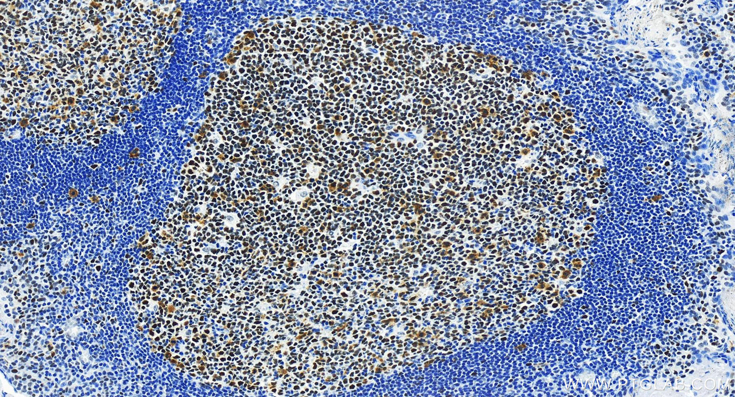 IHC staining of human tonsillitis using 82775-1-RR