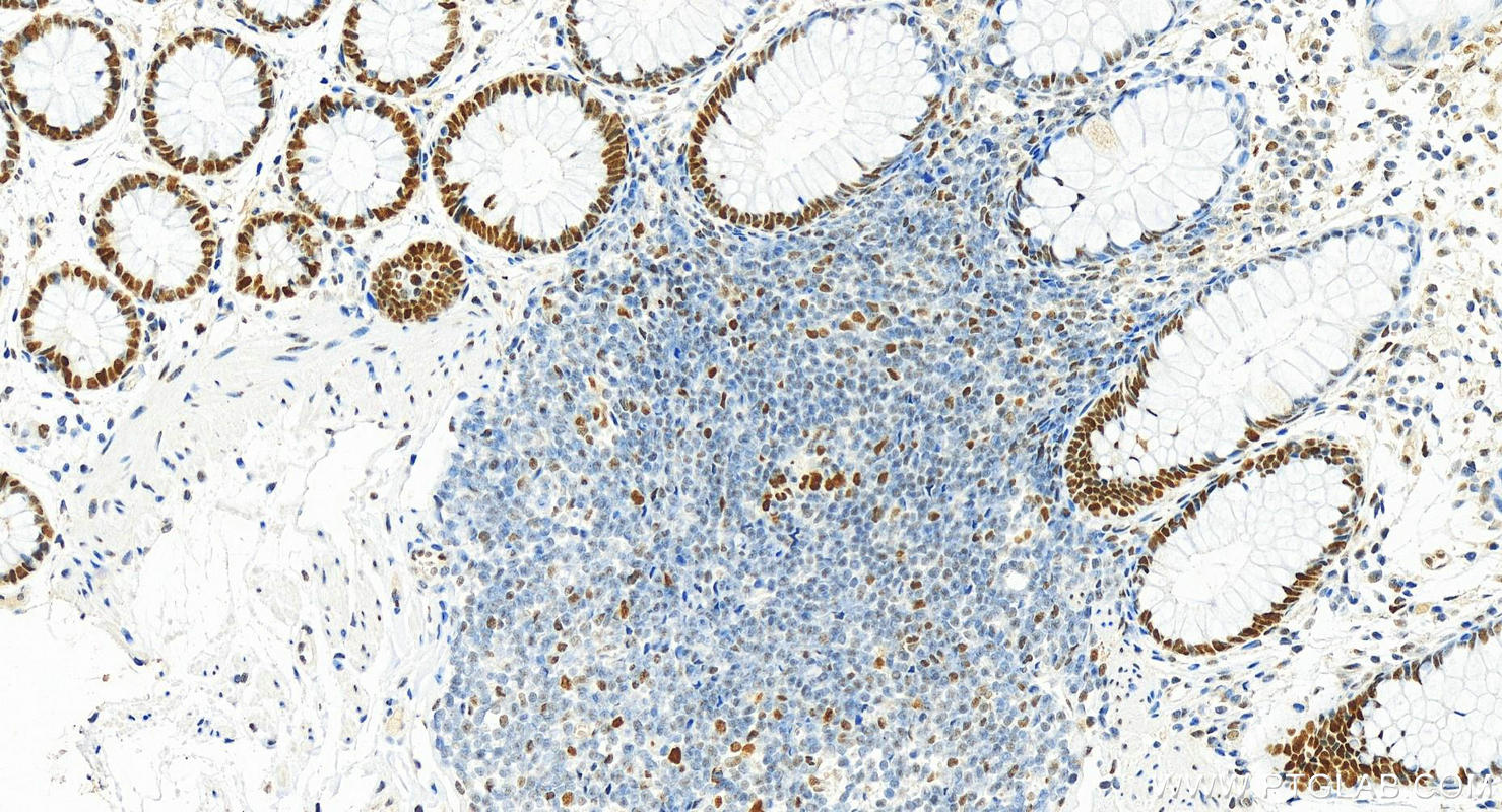 IHC staining of human colon using 66172-2-Ig (same clone as 66172-2-PBS)