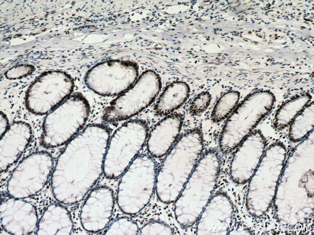 IHC staining of human colon cancer using 66172-2-Ig (same clone as 66172-2-PBS)