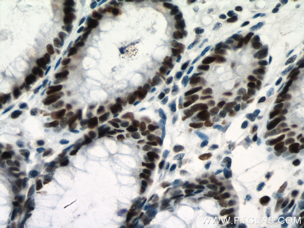 IHC staining of human colon cancer using 66172-2-Ig