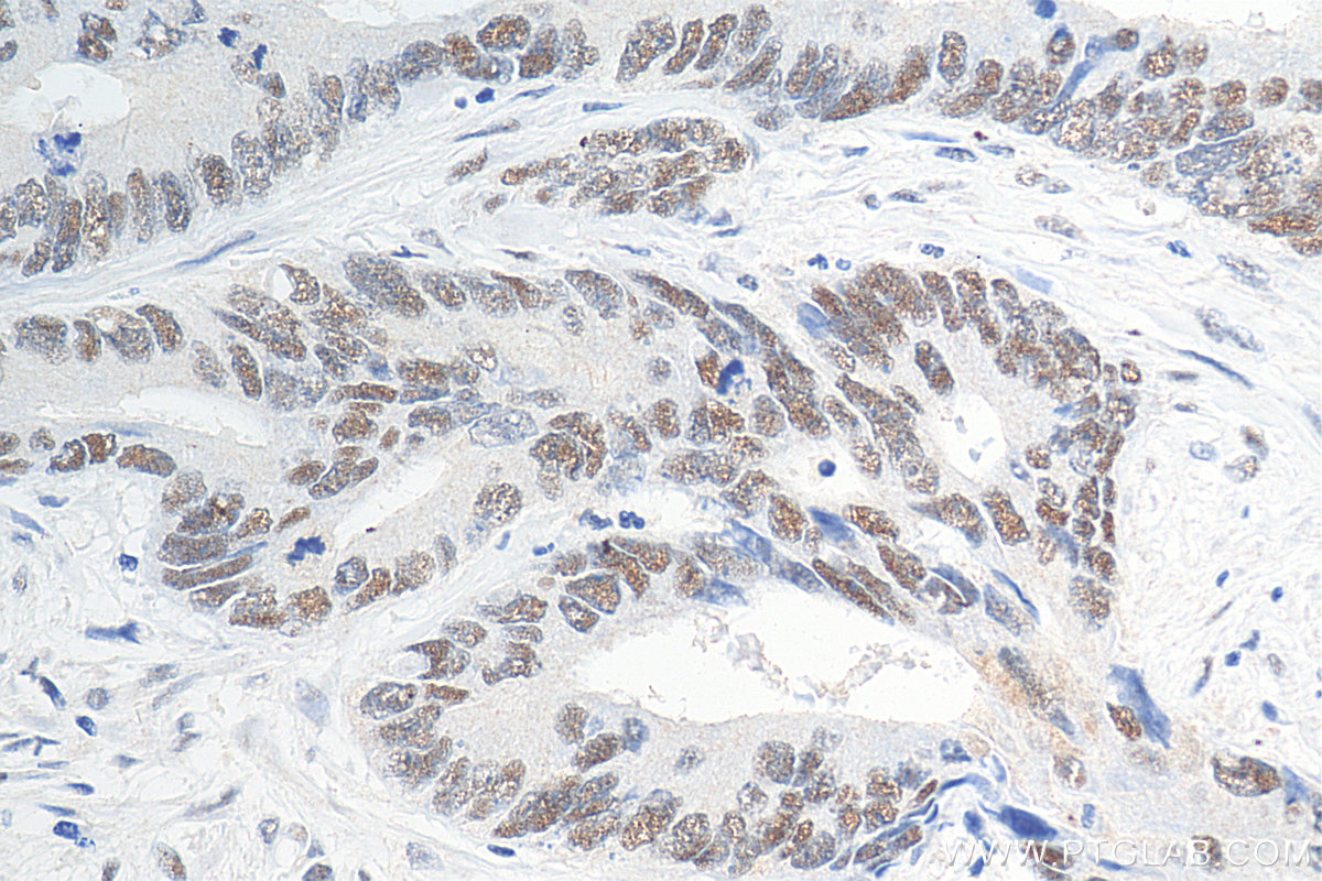 IHC staining of human colon cancer using 66172-2-Ig (same clone as 66172-2-PBS)