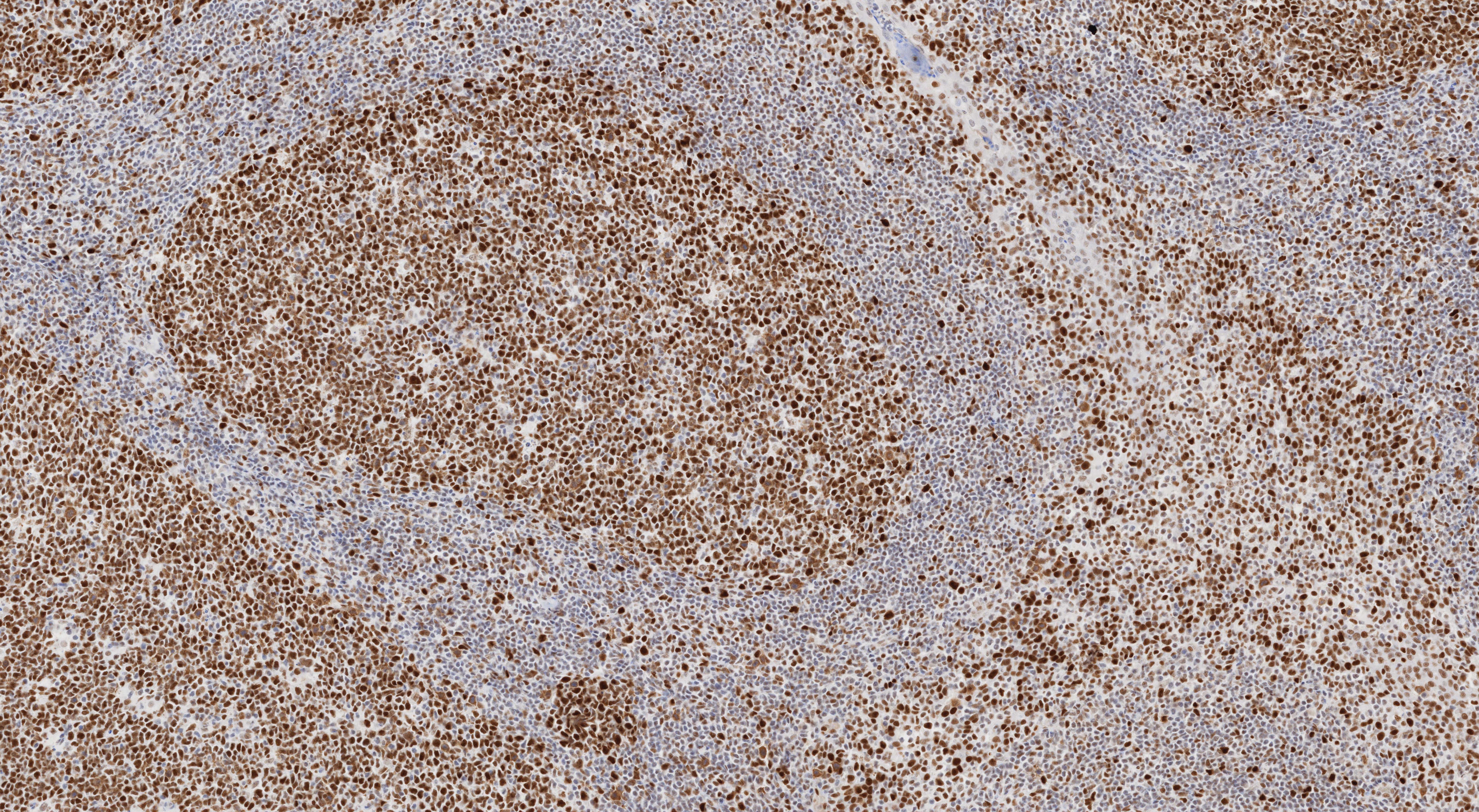 IHC staining of human tonsillitis using 66172-2-Ig