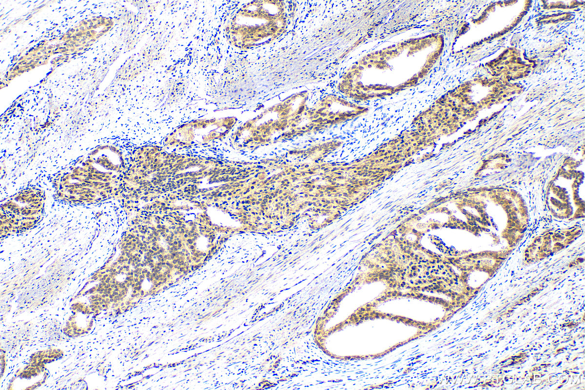 IHC staining of human prostate cancer using 30545-1-AP