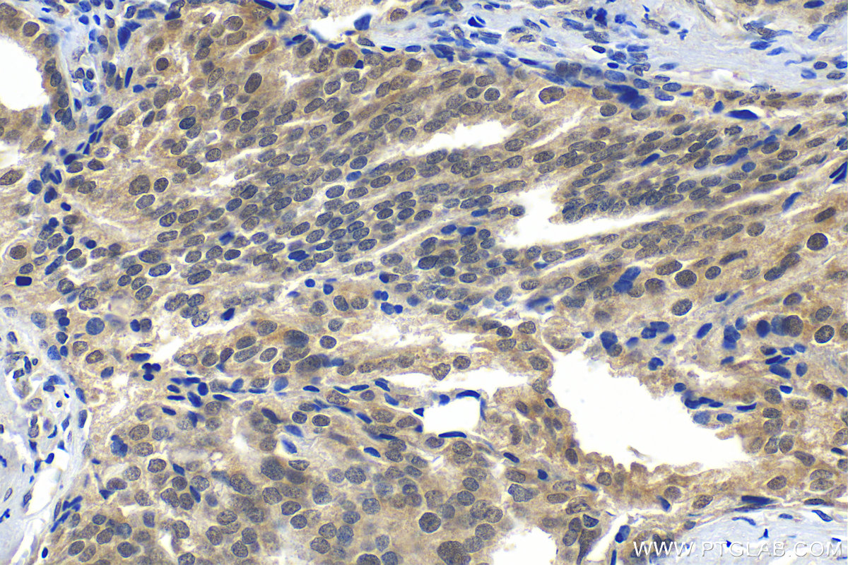 IHC staining of human prostate cancer using 30545-1-AP