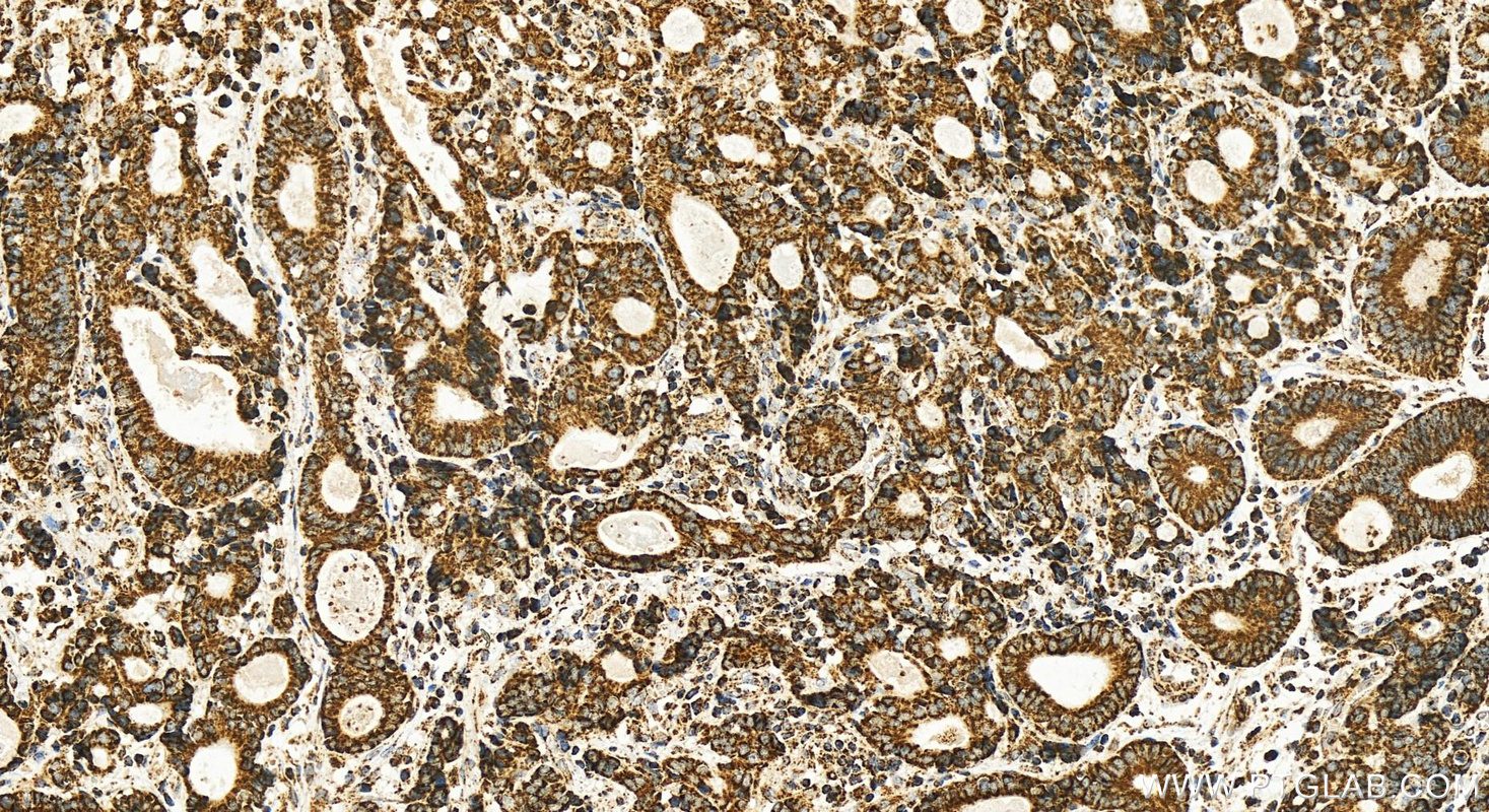 IHC staining of human stomach cancer using 83132-7-RR