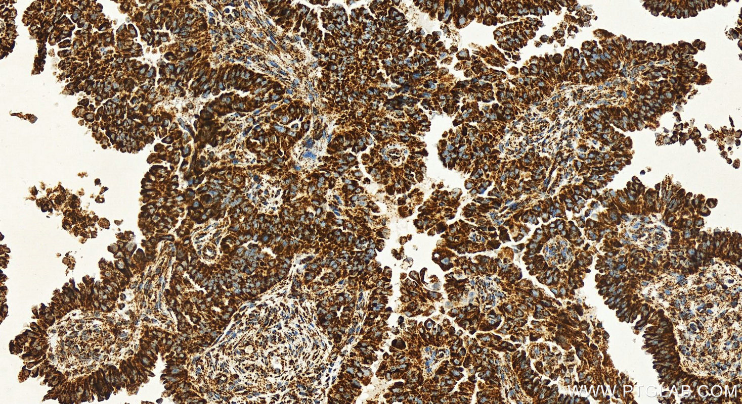 IHC staining of human ovarian cancer using 83132-7-RR