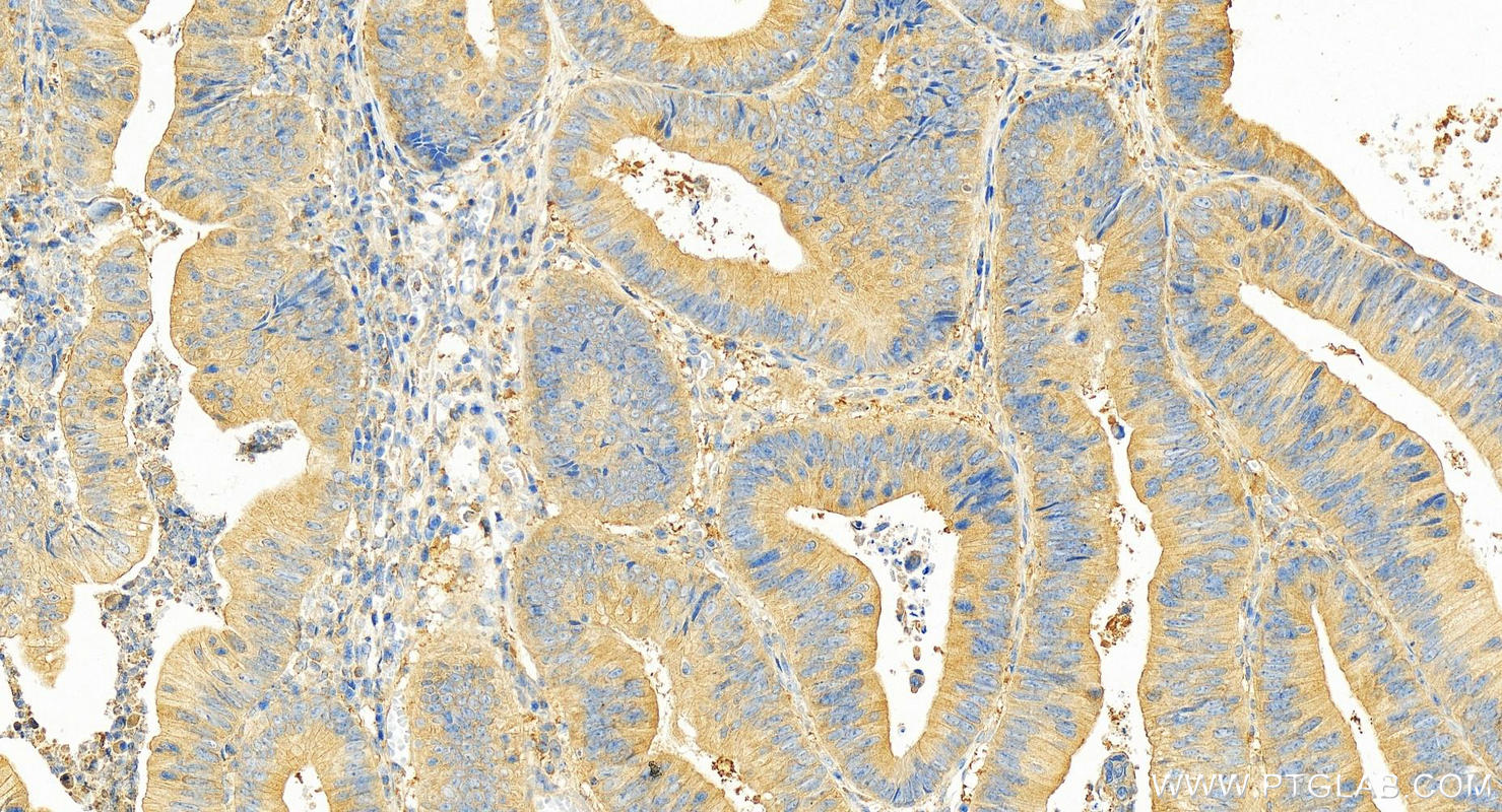 IHC staining of human colon cancer using 10794-1-AP