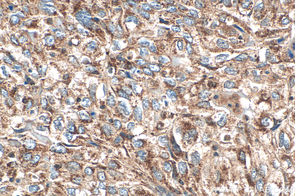 IHC staining of human lung cancer using 68524-1-Ig (same clone as 68524-1-PBS)