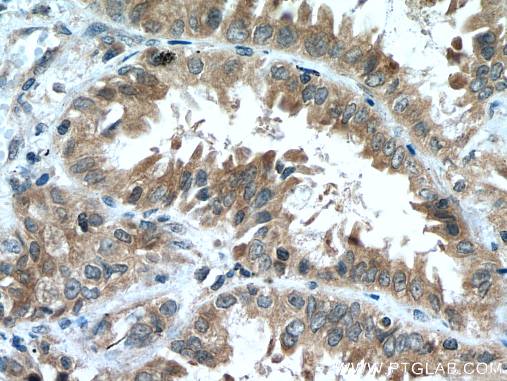 IHC staining of human lung cancer using 13995-1-AP