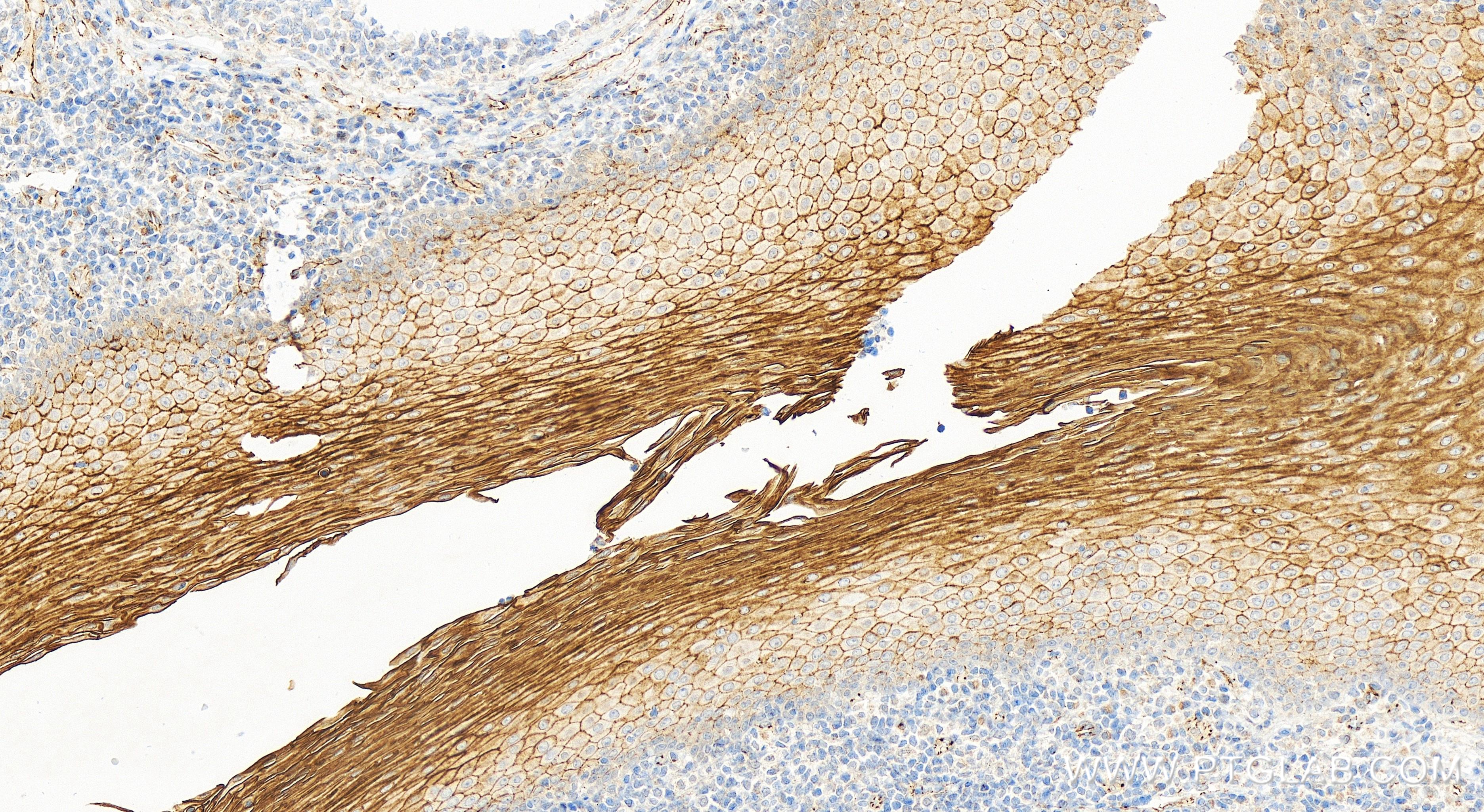 IHC staining of human tonsillitis using 83311-4-RR