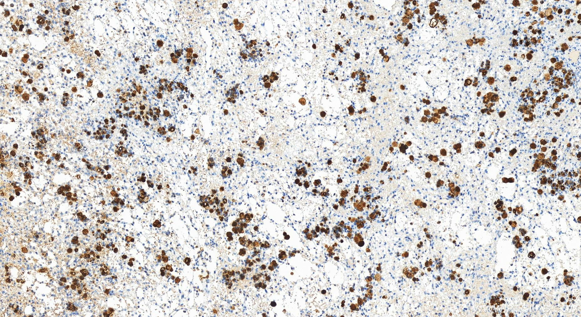 IHC staining of human ovary cancer using 83311-4-RR