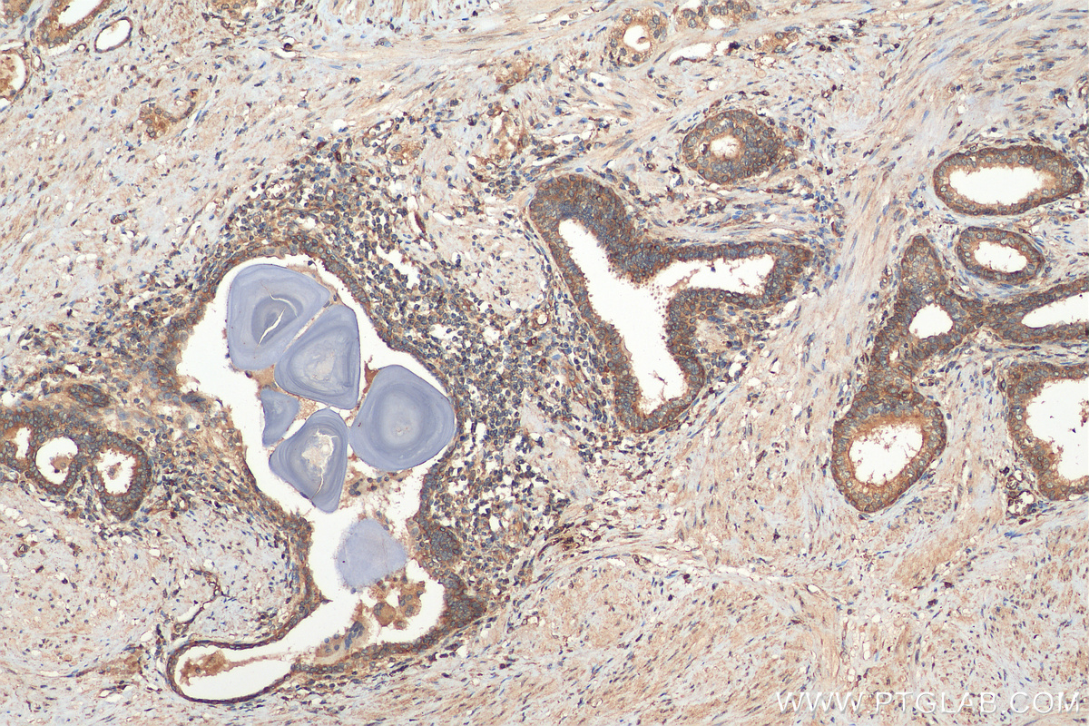 IHC staining of human prostate cancer using 28703-1-AP