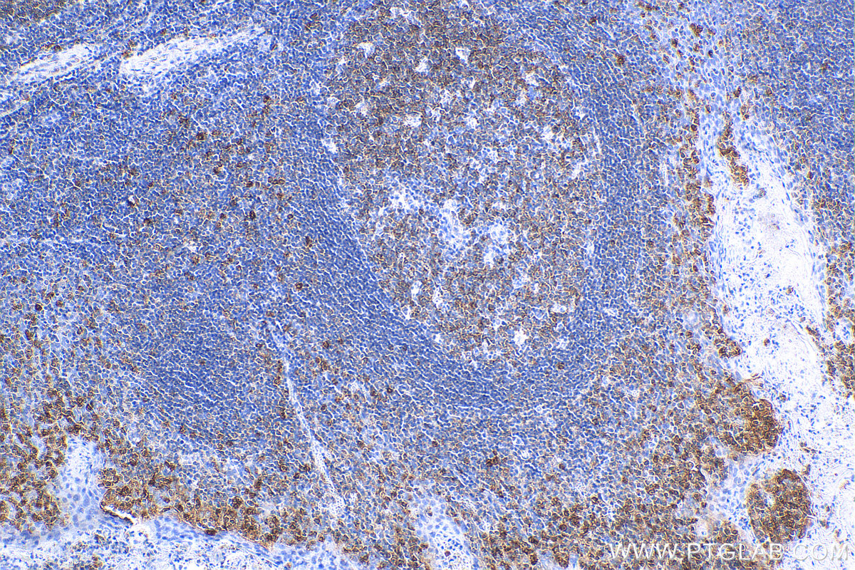 IHC staining of human tonsillitis using 82677-1-RR (same clone as 82677-1-PBS)